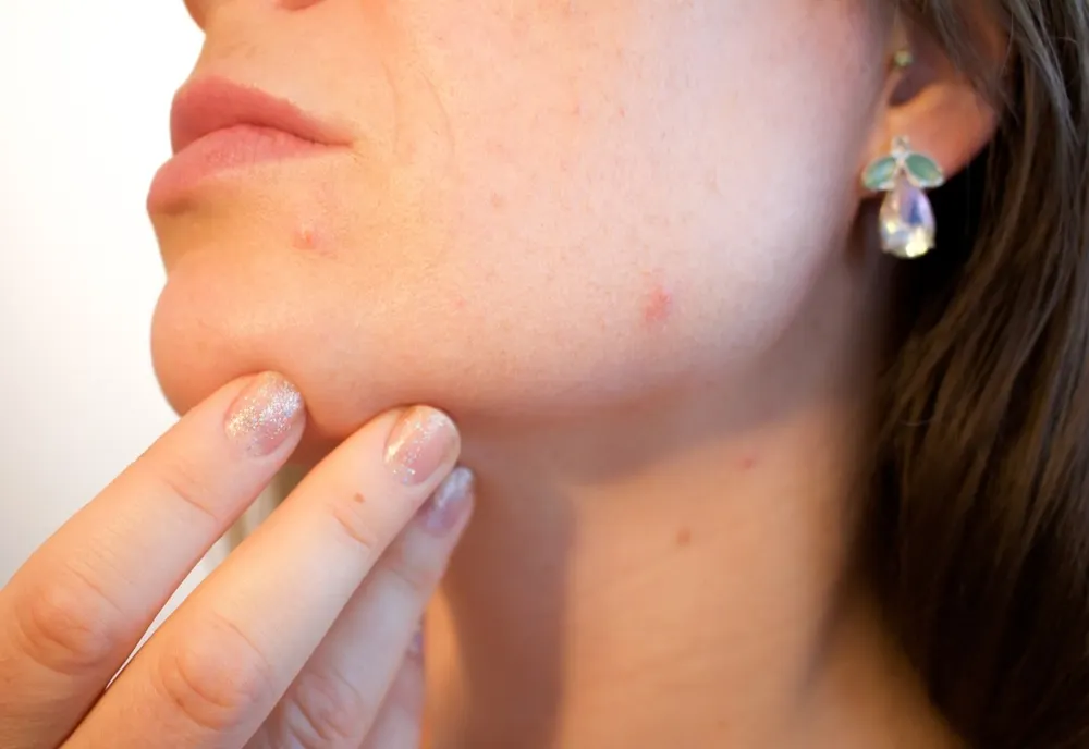 Machiajul agravează acneea? Răspunsul unui dermatolog