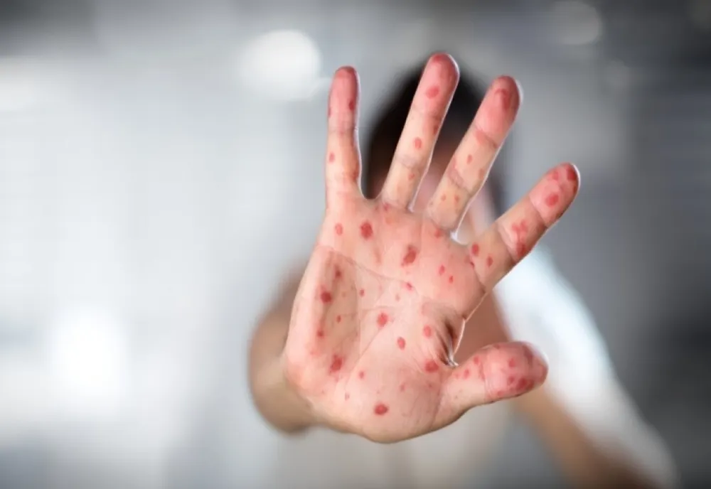 EPIDEMIE de RUJEOLĂ în România. Cum te poți proteja de această afecțiune contagioasă
