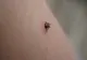 O alergie care pune viața în pericol, cauzată de mușcăturile de căpușe