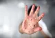 EPIDEMIE de RUJEOLĂ în România. Cum te poți proteja de această afecțiune contagioasă