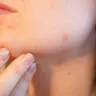 Cum să faci diferența dintre acnee și rozacee?