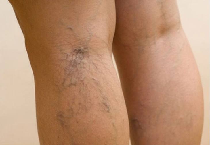 Simptome ale varicelor masculine ale picioarelor