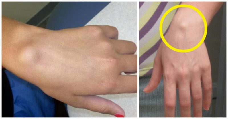 articulația pe încheietura mâinii drepte doare articulații artrite gouty gouty